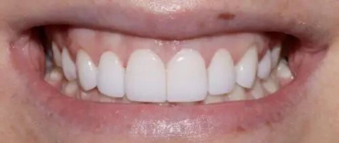 Smile Makeover & Veneers: Case 25 - After