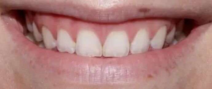 Smile Makeover & Veneers: Case 25 - Before