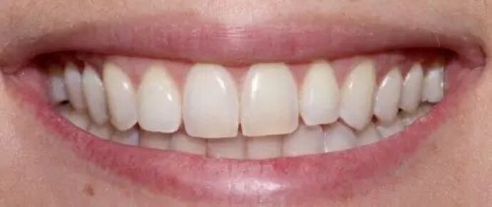 Smile Makeover & Veneers: Case 26 - Before