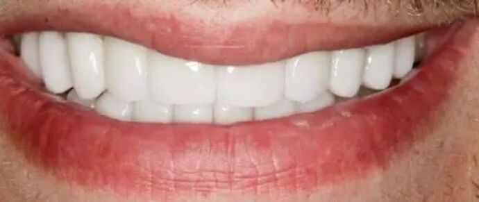Smile Makeover & Veneers: Case 27 - After