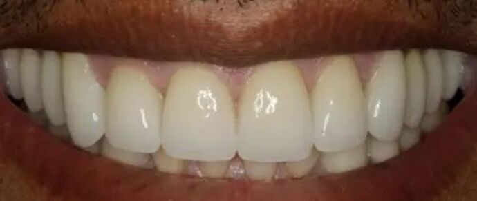 Smile Makeover & Veneers: Case 28 - After