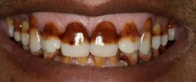 Smile Makeover & Veneers: Case 28 - Before
