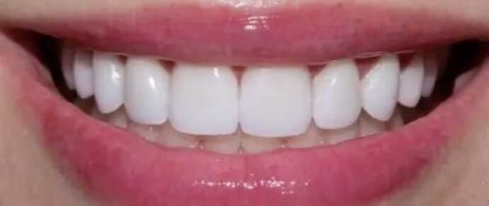Smile Makeover & Veneers: Case 30 - After