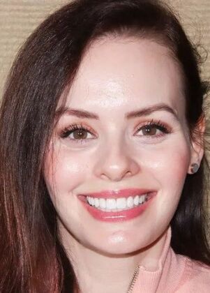 Smile Makeover & Veneers: Case 30 - After
