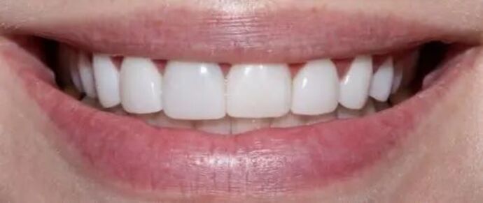 Smile Makeover & Veneers: Case 30 - Before