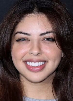 Smile Makeover & Veneers: Case 31 - After