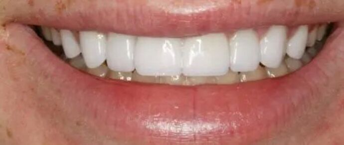 Smile Makeover & Veneers: Case 32 - After