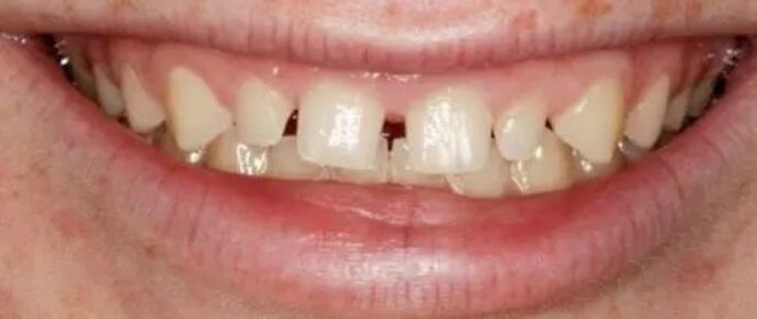 Smile Makeover & Veneers: Case 32 - Before