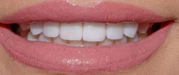 Smile Makeover & Veneers: Case 34 - After