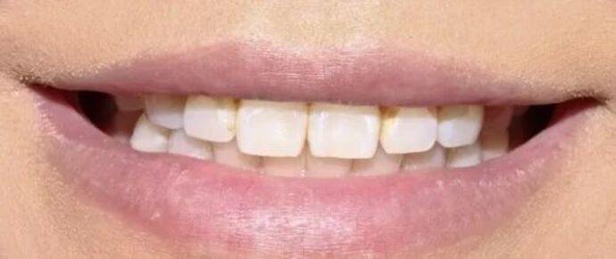 Smile Makeover & Veneers: Case 34 - Before