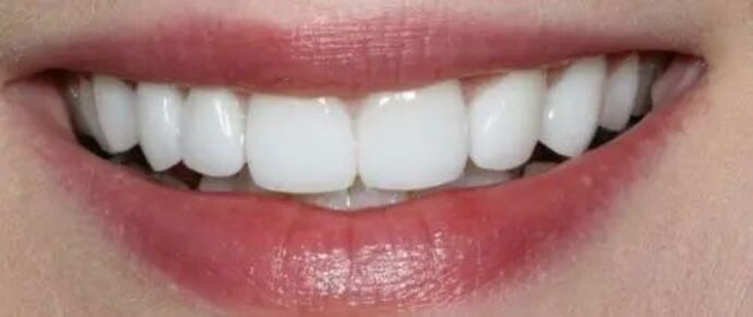 Smile Makeover & Veneers: Case 36 - After