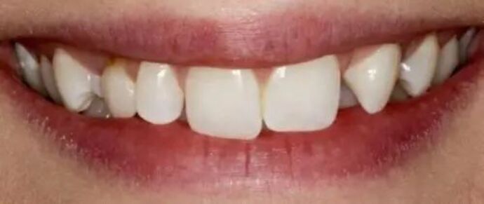 Smile Makeover & Veneers: Case 36 - Before