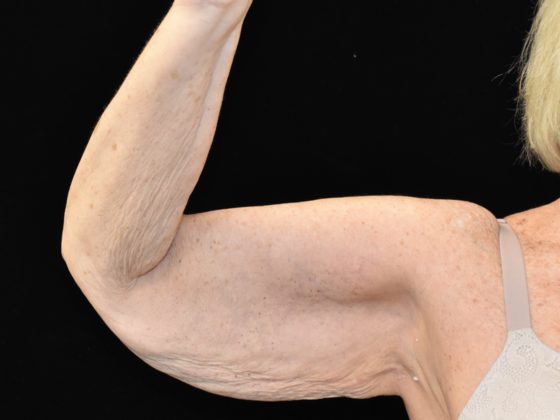 Brachioplasty Case 2 - Before