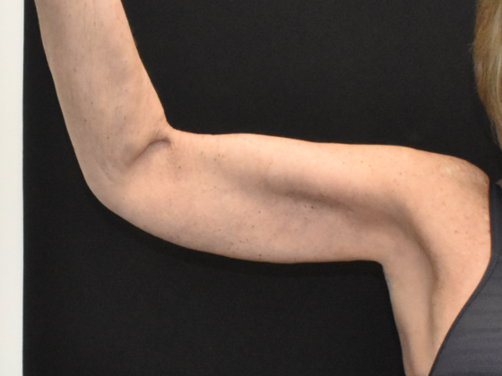 Brachioplasty Case 2 - After