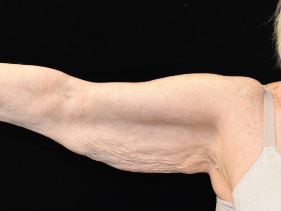 Brachioplasty: Case 2 - Before