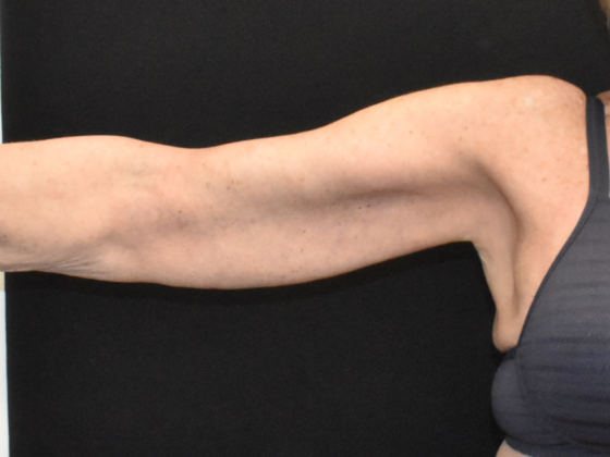 Brachioplasty: Case 2 - After