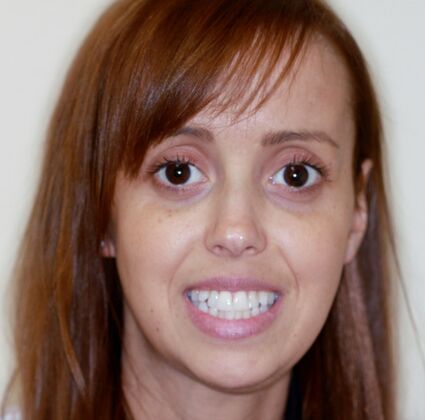 Porcelain Veneers: Case 35 - Before