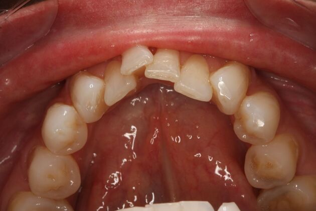 Porcelain Veneers: Case 35 - Before treatment