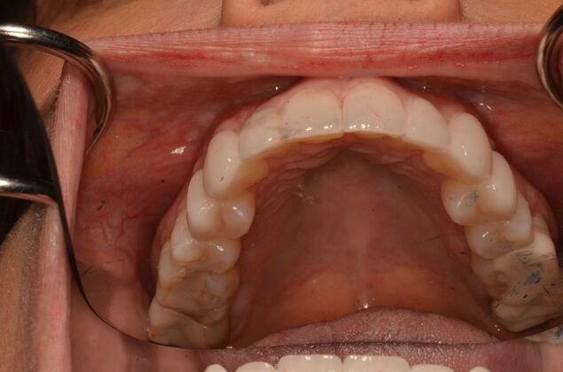 Porcelain Veneers: Case 35 - After treatment