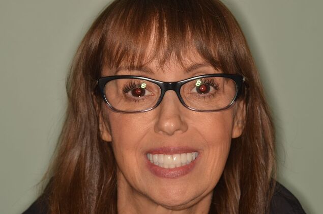 Invisalign: Case 24 - After Invisalign and Porcelain veneer