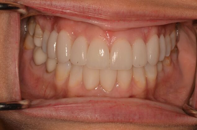 Invisalign: Case 24 - After Invisalign and Porcelain veneer