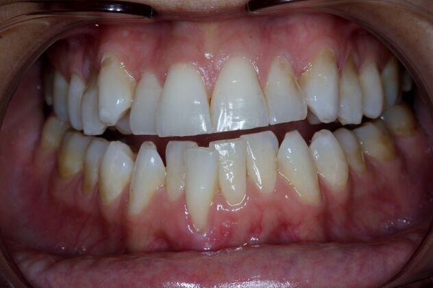 Invisalign: Case 24 - Before invisalign and porcelain veneers