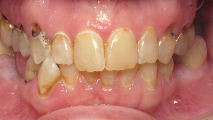 Teeth in a Day: No longer saddened by failing, decaying, missing teeth - Before