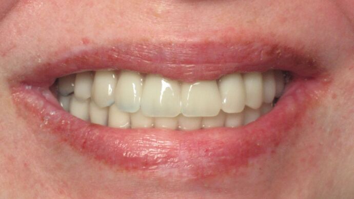 Teeth in a Day: No longer saddened by failing, decaying, missing teeth - After