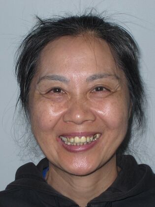 Teeth in a Day: Ecstatic to have a full bright smile again - Before