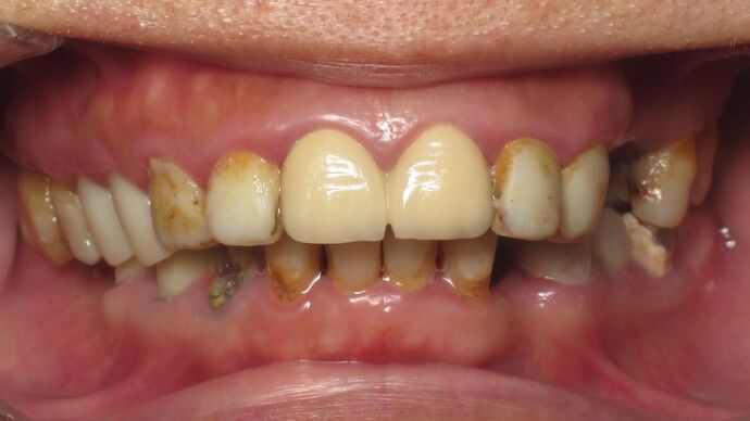 Teeth in a Day: Ecstatic to have a full bright smile again - Before