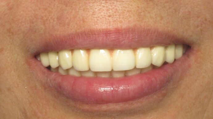 Teeth in a Day: Ecstatic to have a full bright smile again - After