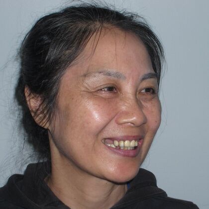 Teeth in a Day: Ecstatic to have a full bright smile again - Before