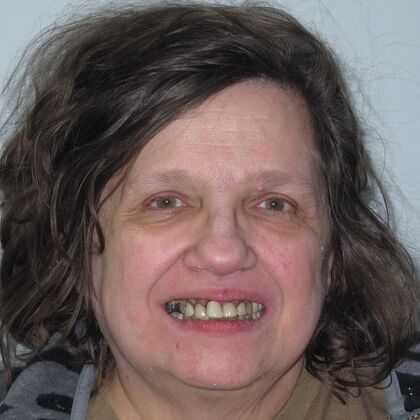 Teeth in a Day: New Teeth, New Life - Before