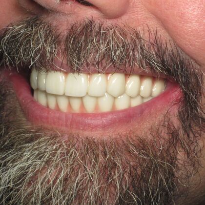 Teeth in a Day: Even a smile in ruins can return - After