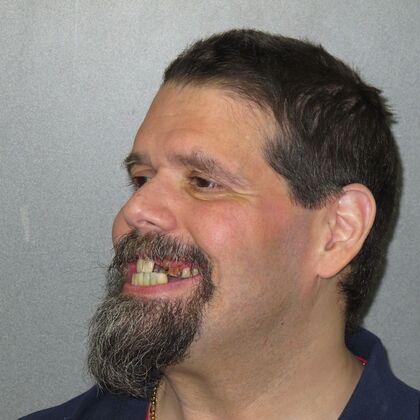 Teeth in a Day: Even a smile in ruins can return - After