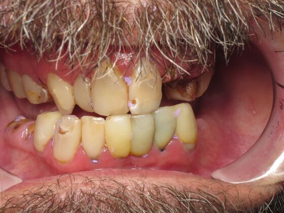 Teeth in a Day: Even a smile in ruins can return - Before