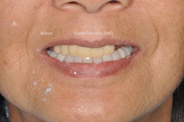 Full Mouth Reconstruction: Case 2 - Before