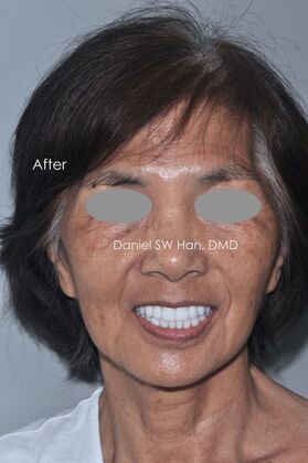 Full Mouth Reconstruction Case 2