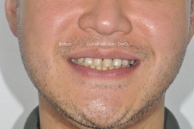 Full Mouth Reconstruction: Case 3 - Before