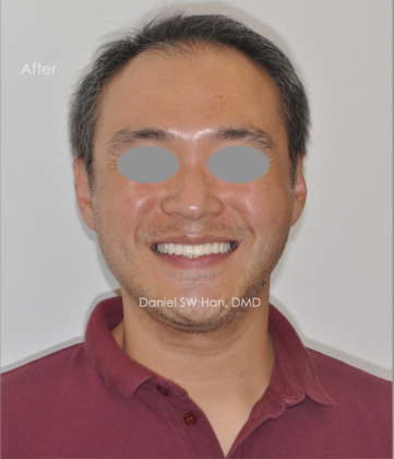 Full Mouth Reconstruction Case 3