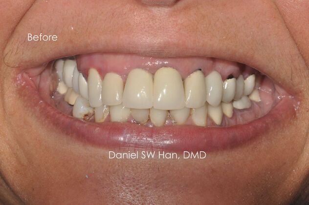 Full Mouth Reconstruction: Case 4 - Before