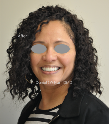 Full Mouth Reconstruction Case 4