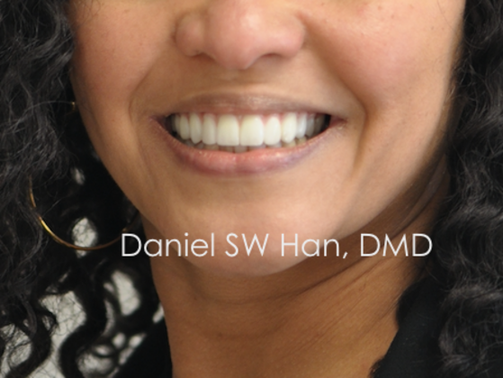Cosmetic Dentistry: Case 14 - After