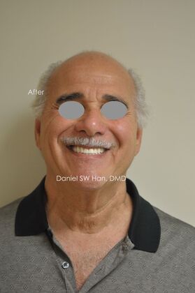 Full Mouth Reconstruction Case 5 - After