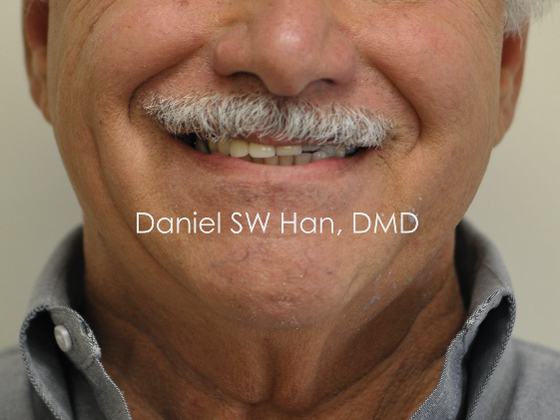 Cosmetic Dentistry: Case 16 - Before