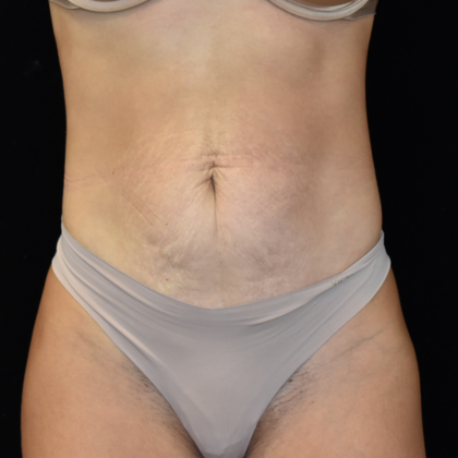 Abdominoplasty Case 9 - Before