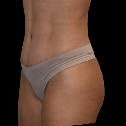 Abdominoplasty: Case 9 - After