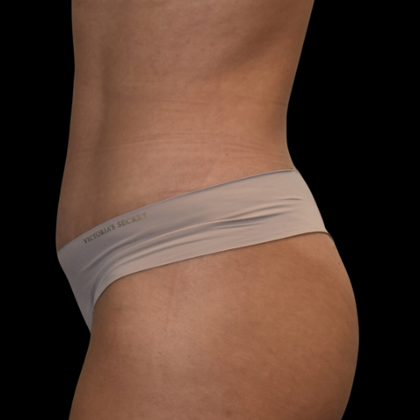 Abdominoplasty: Case 9 - After