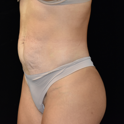 Abdominoplasty: Case 9 - Before