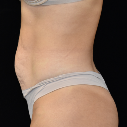 Abdominoplasty: Case 9 - Before